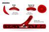 Sickle-Cell-Anaemia